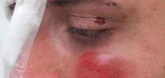 Homem é preso após agredir mulher brutalmente em MT; vítima ficou cega de um olho