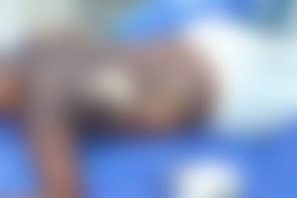 Adolescente de 13 anos cai em armadilha e sofre queimaduras graves em Sorriso