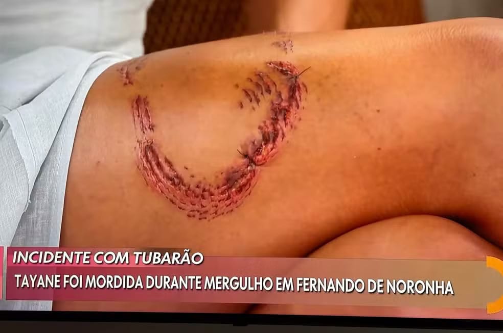 Turista mostra perna com marcas de mordida de tubarão: 'É uma dor muito forte'