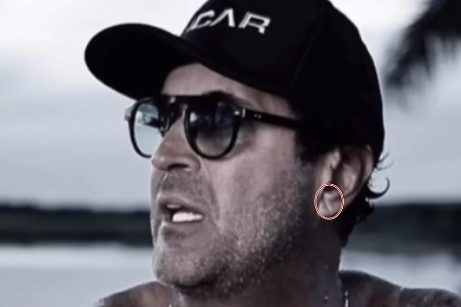 Sinal de Frank: cardiologista explica quadro que pode anteceder infarto