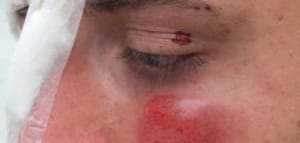 Homem é preso após agredir mulher brutalmente em MT; vítima ficou cega de um olho